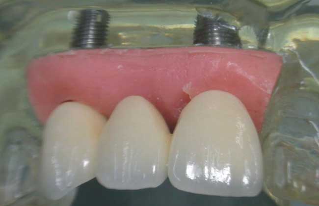 种植牙齿的危害与好处