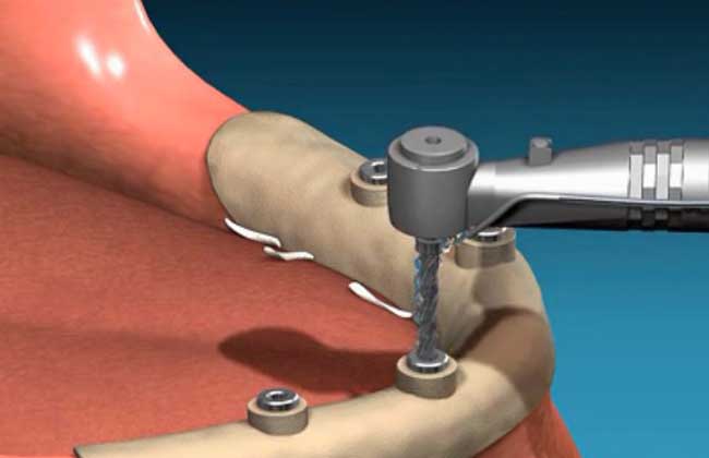 种植牙好还是镶牙好？