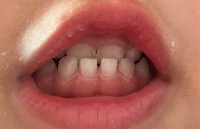 牙齿松动怎么办才好?