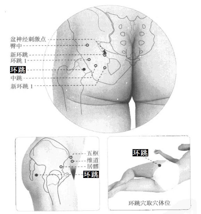 环跳的证治纲要与定位图解