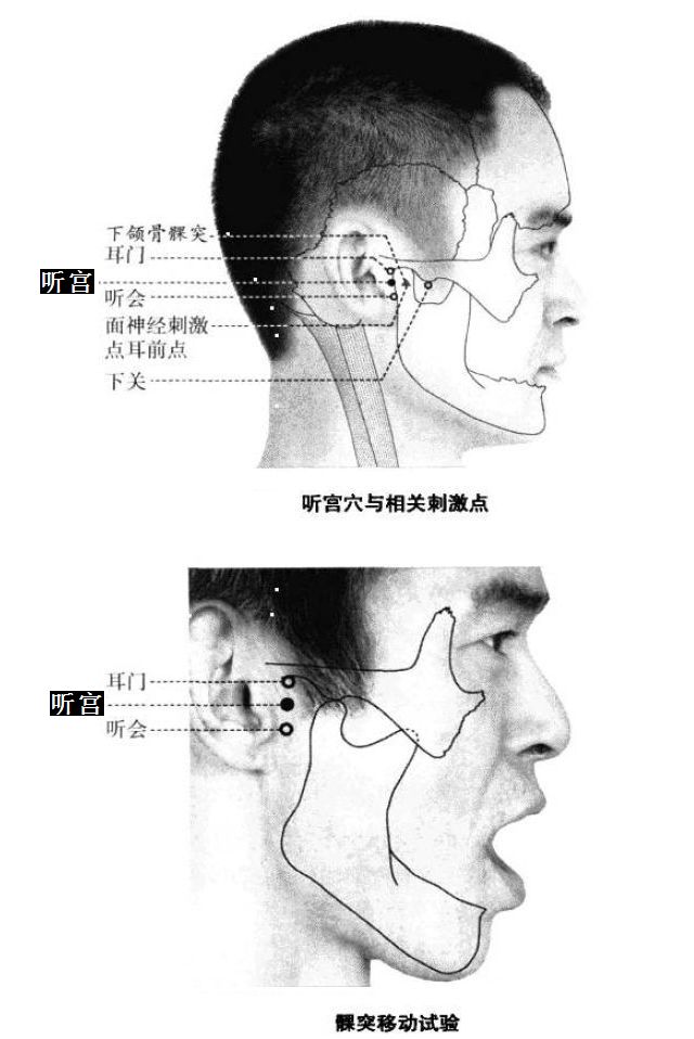 听宫的证治纲要与定位图解